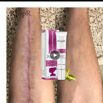 Acne Scar Removal Cream for Skin Repair and Healing Ferdigstelt